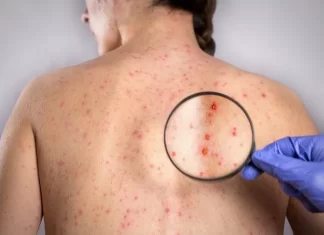 Dünyada sifilis xəstəliyi yayıldı – Rekord hədd